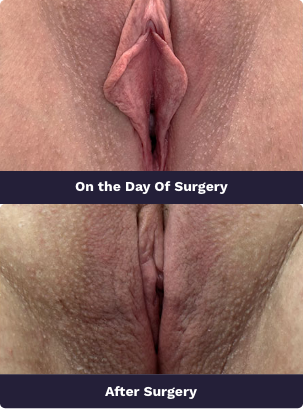 labiaplasty at ahalya cosmetic gynecology