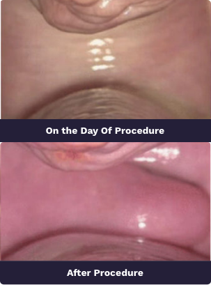 laser vaginal tightening at  ahalya cosmetic gynecology<br />
