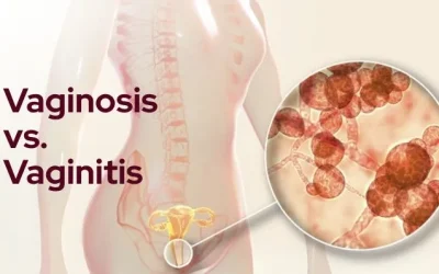 What is the Difference Between Vaginosis and Vaginitis?