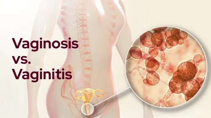 Vaginosis vs. Vaginitis