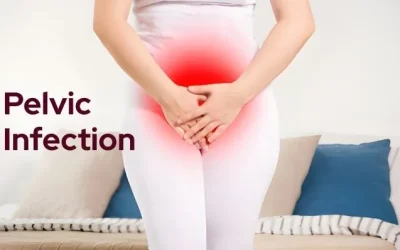 How Serious Is a Pelvic Infection? A Doctor Explains PID