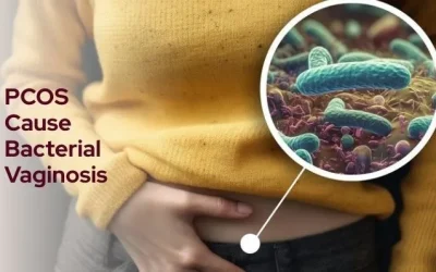 Can PCOS Cause Bacterial Vaginosis?