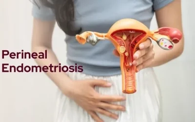 What Is Perineal Endometriosis? A Simple Explanation