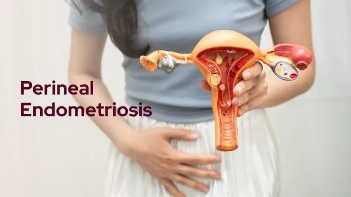 Perineal Endometriosis
