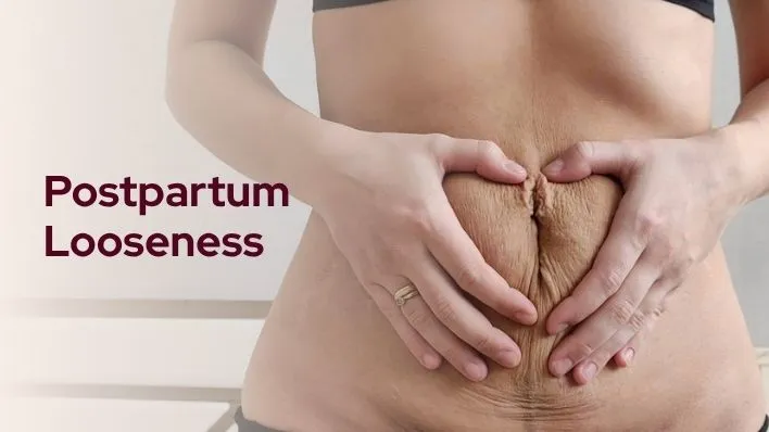 Postpartum Looseness
